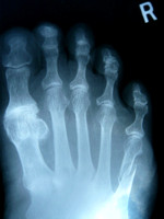 Mak Hospital Visit - Fractured Foot Bone