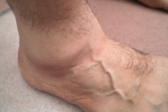 Abbas Ankle Swollen