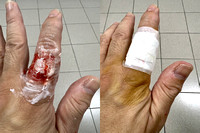 Cat Bite on finger